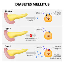Diabetes Mellitus Diagram